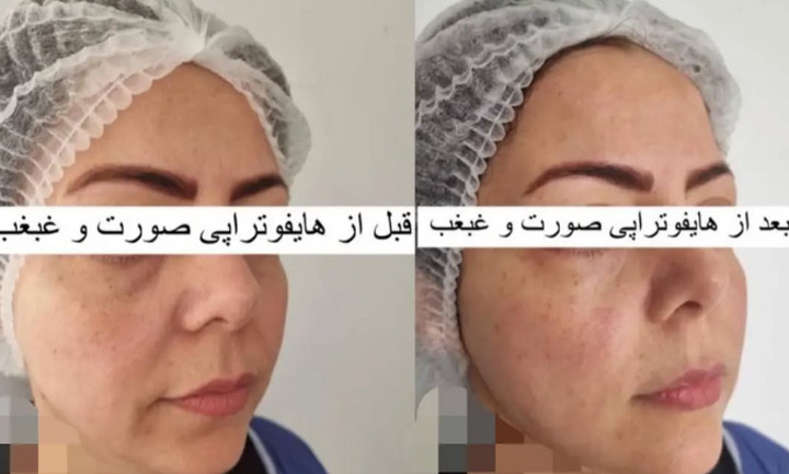 بهترین مرکز هایفوتراپی صورت در قم