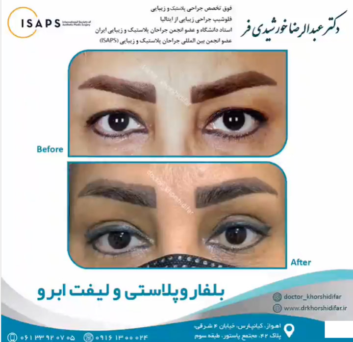 بهترین پزشک جراحی پلک اهواز