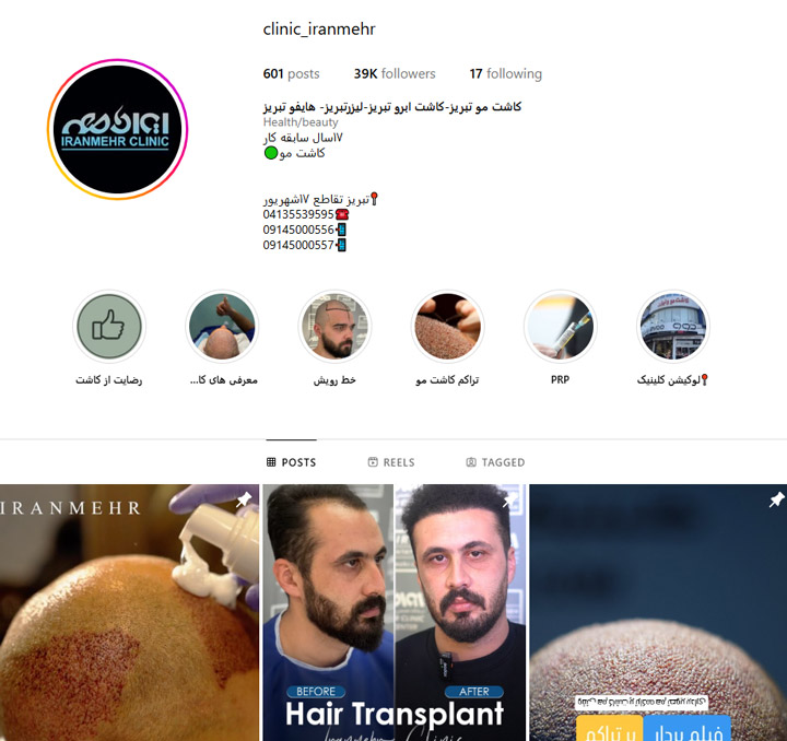 کاشت مو ایرانمهر تبریز