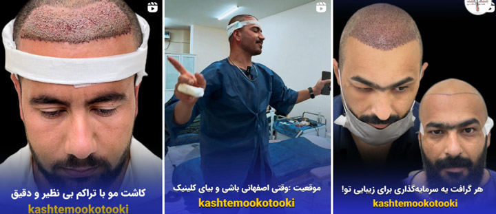 مرکز کاشت مو اهواز