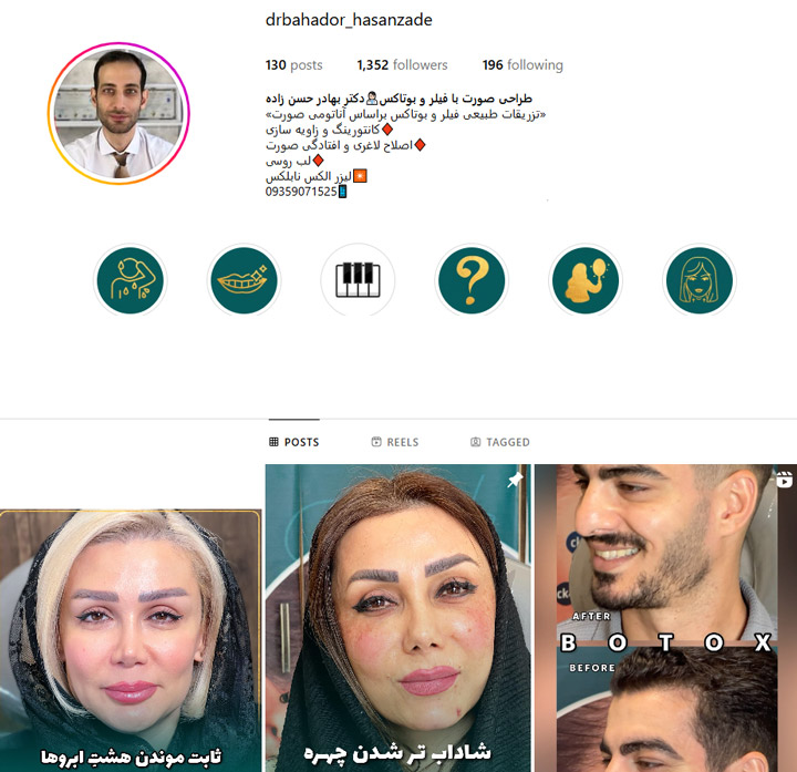 فیلر گونه رشت