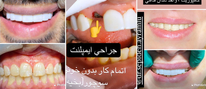 کامپوزیت قسطی در تبریز