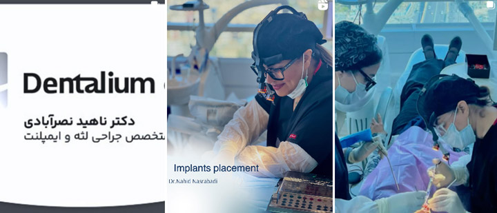 بهترین مرکز ایمپلنت دندان در مشهد