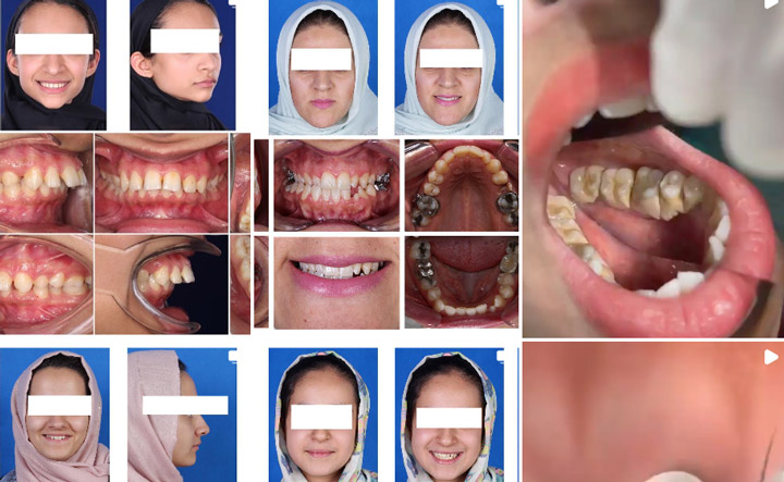 ارتودنسی نامرئی در قم